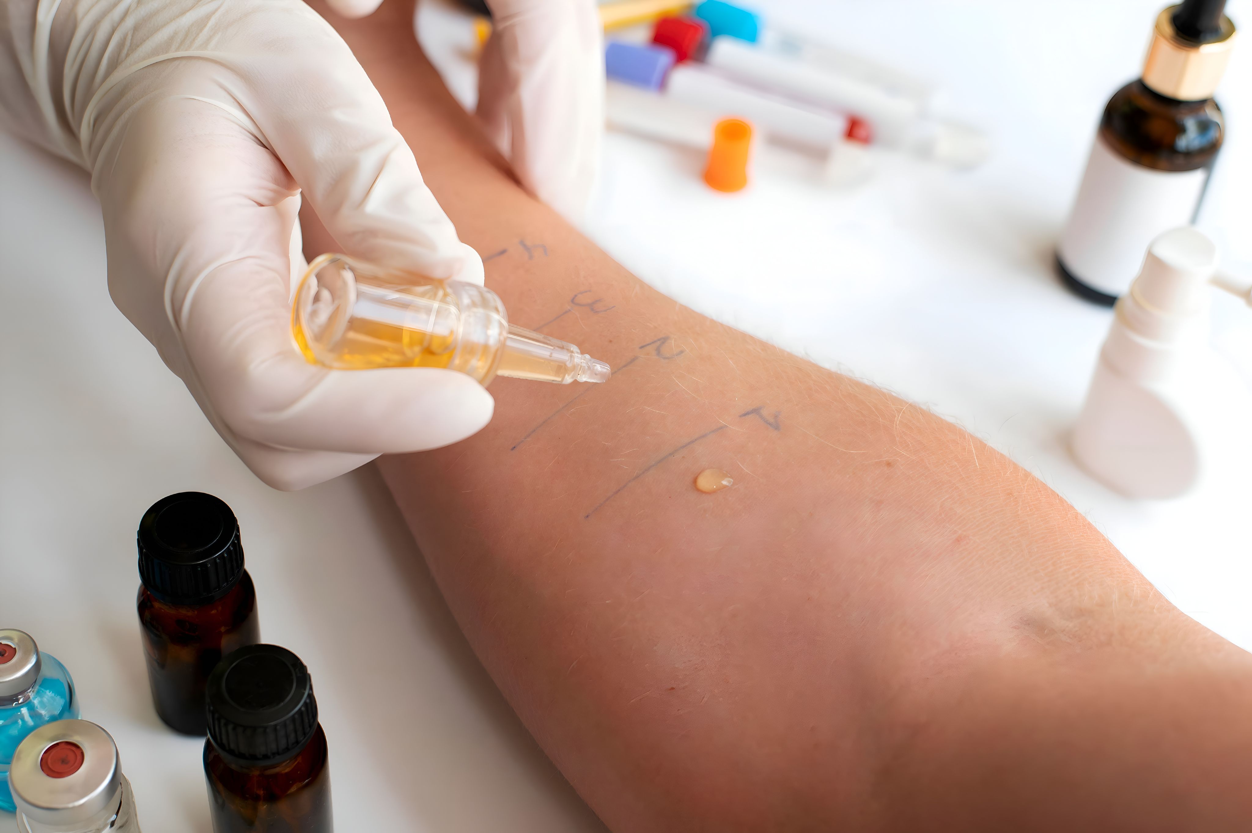 Allergy Tests at Nairobi Skin Centre